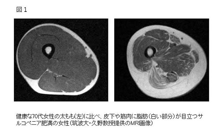 Vol.26：アナタは大丈夫？ 一見普通の体格でも…メタボより怖い“隠れ肥満（サルコペニア肥満）”